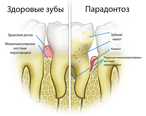 parodontoz (2)