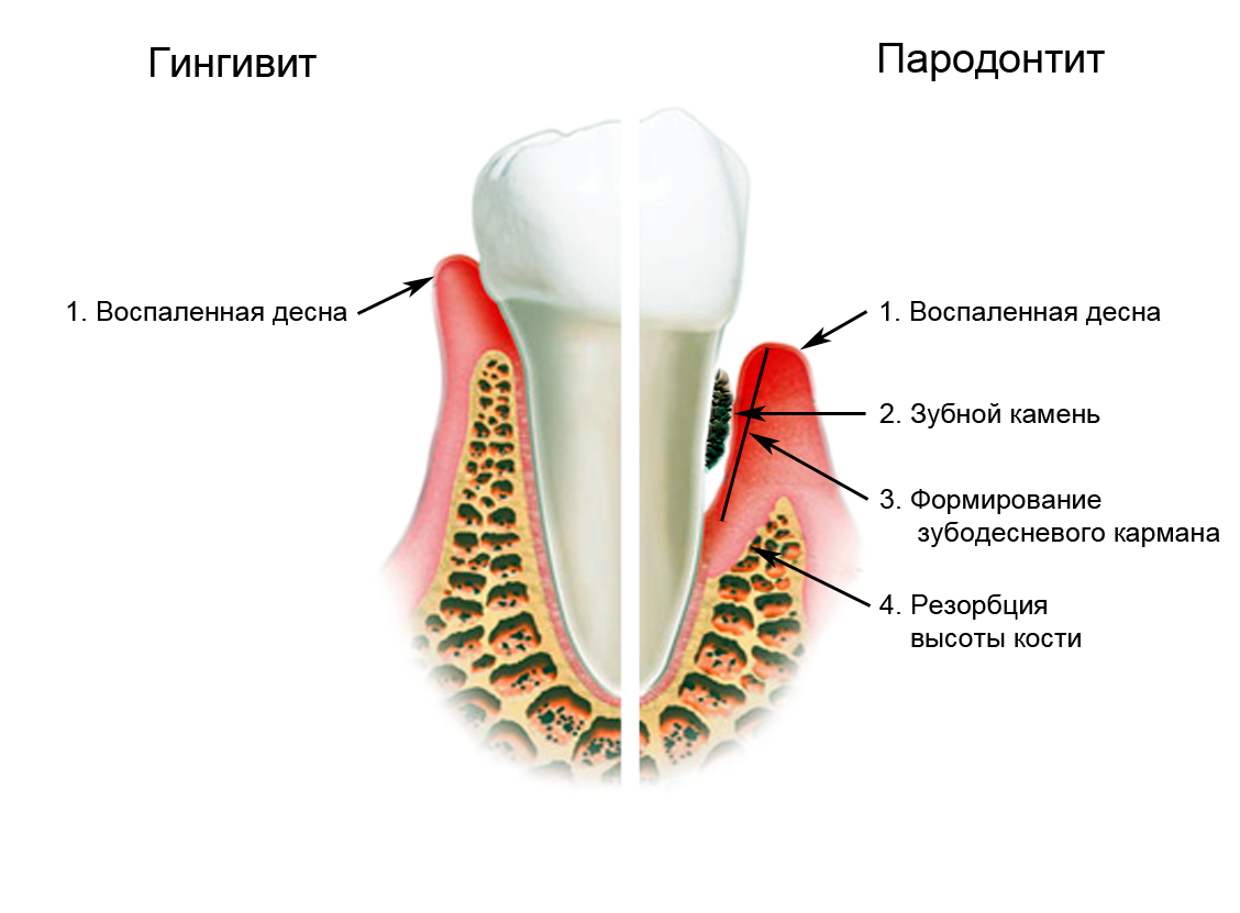 лечение-десен-пародонтит-18